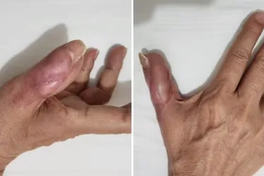 
				Mulher perde parte do dedo após fazer as unhas em salão
			
			