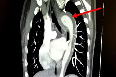 
				Mulher rompe aorta ao atingir o orgasmo: 'Dor intensa parecia facadas'
			
			