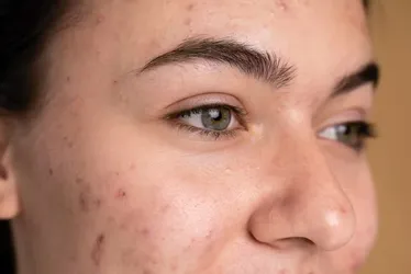 
			
				Roacutan contra acne: remédio usado por Ana Castela tem restrições
			
			