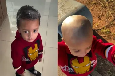 
				Vídeo: criança usa creme depilatório na cabeça e perde o cabelo
			
			