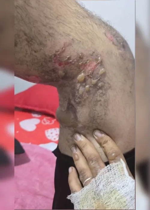 
				Motorista de app queimado vivo fala pela primeira vez e pede ajuda: “Tou vivo por um milagre”
			
			