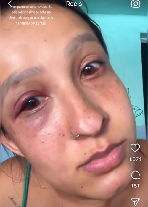 
			
				Recusou sexo e foi espancada: mulher denuncia companheiro por agressão no Tabuleiro
			
			
