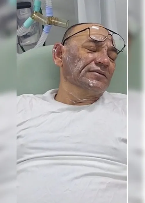
				Sargento da PM é atingido com óleo quente no rosto ao prestar apoio à ocorrência com paciente psiquiátrico
			
			