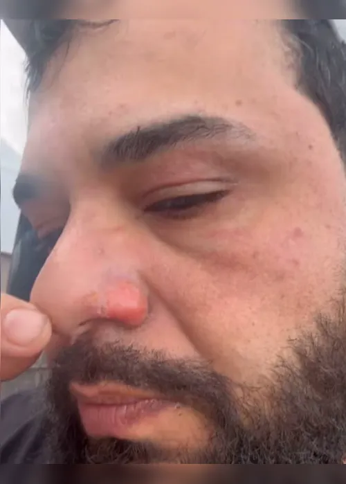 
			
				Sertanejo Léo mostra como ficou seu rosto após ser queimado em show
			
			