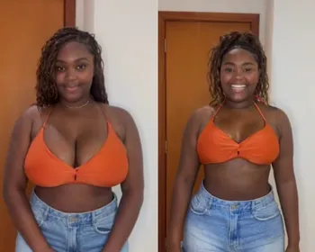 Ex-BBB Raquele mostra antes e depois da cirurgia de redução de mamas