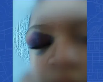 Mãe denuncia creche de Maceió após filho autista voltar com hematomas