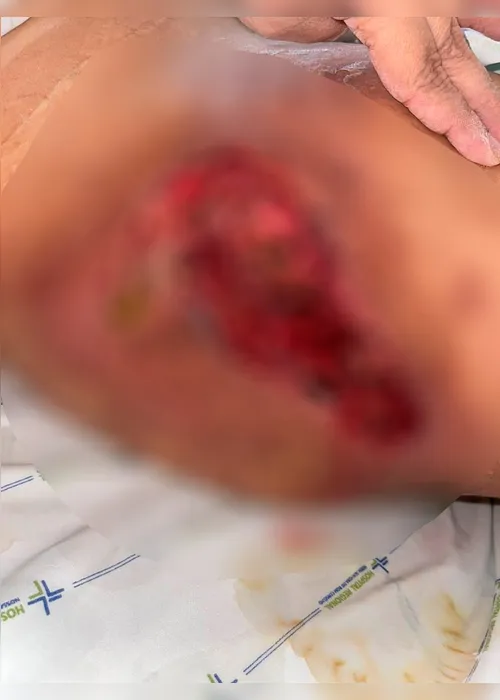 
				Glúteo necrosado: PC prende dentista que aplicava silicone industrial em pacientes de Arapiraca
			
			