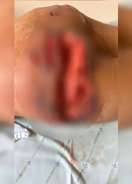 
				Glúteo necrosado: PC prende dentista que aplicava silicone industrial em pacientes de Arapiraca
			
			