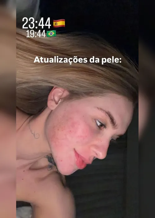 
				Virginia mostra rosto após procedimento que o deixou em carne viva
			
			