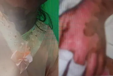 <br /> Ex-namorado é investigado por atear fogo em adolescente; vítima tem medida protetiva<br /><br />