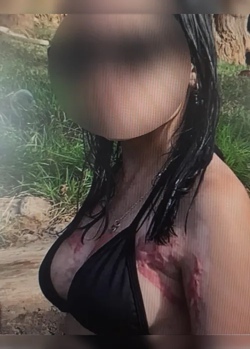 
				Jovem sobrevive a ciclo de violência após ser incendiada pelo namorado em Maravilha
			
			