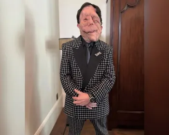Neurofibromatose: entenda doença rara do ator Adam Pearson