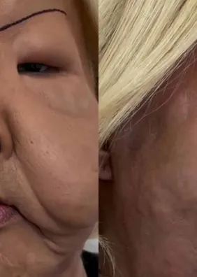 Mudou muito? Médico mostra como ficou Juju do Pix após retirada de óleo mineral do rosto