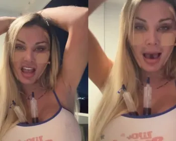 Andressa Urach assusta ao aparecer com rosto modificado e faz revelação: ‘Comunicado importante’