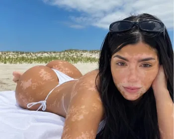 Conheça a influenciadora 18+ com vitiligo universal que viralizou nas redes sociais