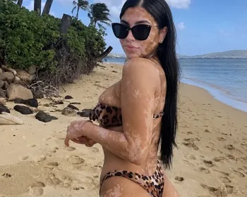 Conheça a influenciadora 18+ com vitiligo universal que viralizou nas redes sociais