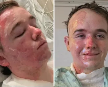 Funcionário do McDonald’s sofre queimaduras graves após ataque com óleo quente