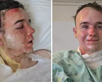Funcionário do McDonald’s tem queimaduras graves após colega de trabalho o atacar com óleo quente