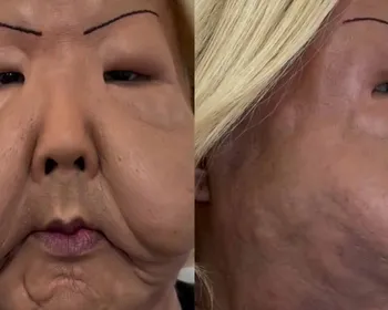 Mudou muito? Médico mostra como ficou Juju do Pix após retirada de óleo mineral do rosto