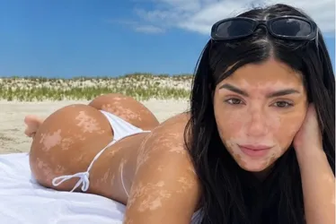
				Conheça a influenciadora 18+ com vitiligo universal que viralizou nas redes sociais
			
			