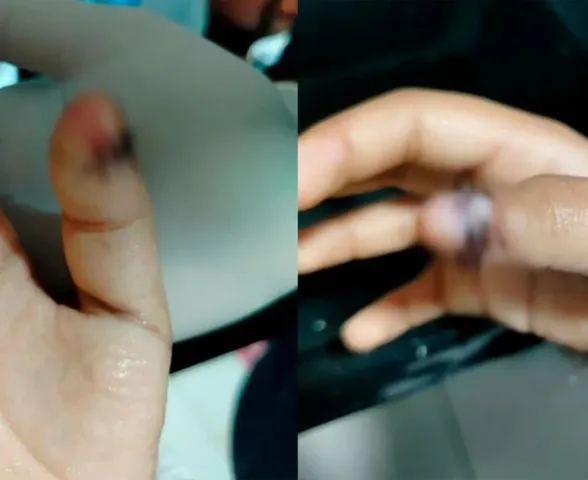 Menino autista tem dedo esmagado na porta da escola e família denuncia