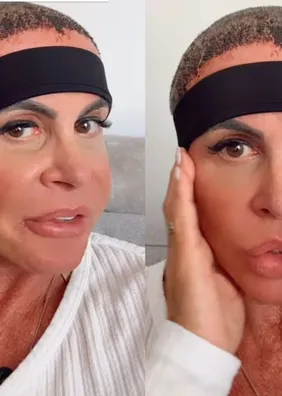Gretchen atualiza sobre recuperação após realizar transplante capilar
