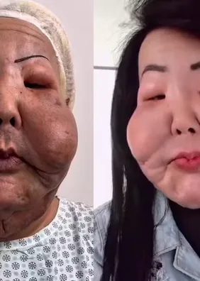Médico mostra antes e depois de Juju do Pix após seis meses de cirurgia para retirada de óleo mineral