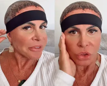 Gretchen atualiza sobre recuperação após realizar transplante capilar