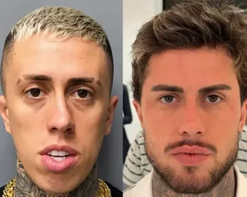 MC Daniel impressiona com antes e depois após procedimentos estéticos: 'outro CPF'