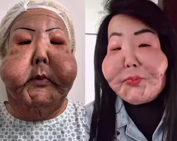 Médico mostra antes e depois de Juju do Pix após seis meses de cirurgia para retirada de óleo mineral