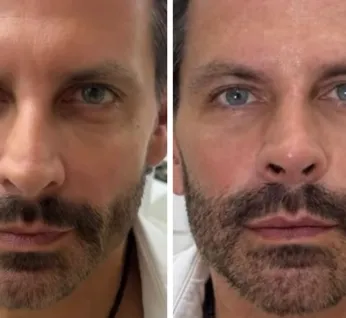Henri Castelli faz nova harmonização facial e surpreende