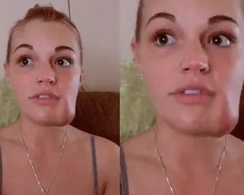 Mulher tenta espremer “espinha” e descobre tumor vascular no rosto