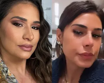 Simone "amarra" fios no nariz em novo procedimento; médico explica técnica