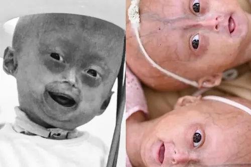 
				Morre Elis, influencer mirim com síndrome rara de envelhecimento precoce
			
			