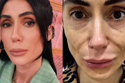 
				Voltaram atrás: 7 famosas que reverteram procedimentos faciais
			
			