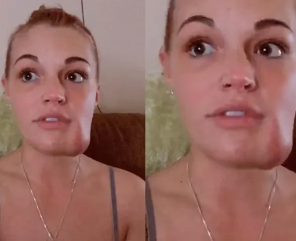 Mulher tenta espremer “espinha” e descobre tumor vascular no rosto