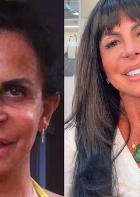 Gretchen diz que já fez 'mais de 100' procedimentos estéticos; veja alguns deles