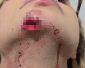 Influenciadora de Maceió relata agressão do ex e diz ter sido arrastada em carro por 100 metros