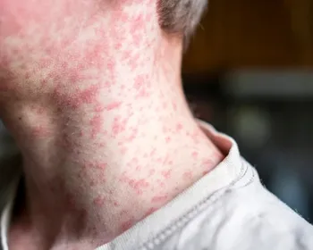 Nova York declara estado de emergência devido a surto de sarampo