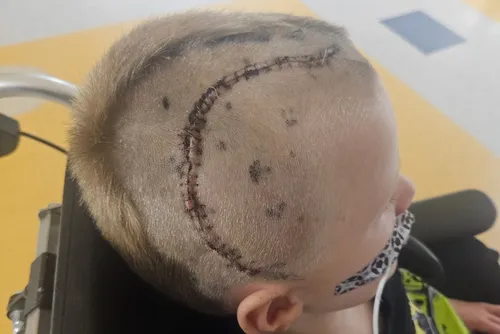 
				Menino de 6 anos começa a ter crises de raiva e é diagnosticado com AVC
			
			