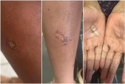 
				Pai tortura e queima filhas de 11 e 12 anos com pegador de carvão
			
			