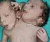 Gêmeos nascem unidos com mesmo tronco, três braços e dois corações na Índia imagem