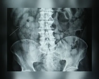 Exame de raio X mostra cápsulas de cocaína no estômago de boliviano