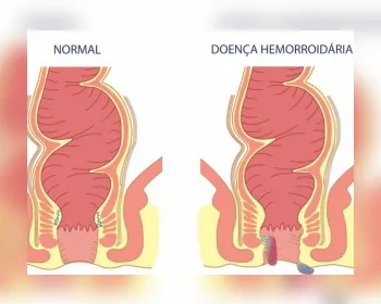 Constipação e diarreias constantes favorecem o desenvolvimento das hemorroidas 