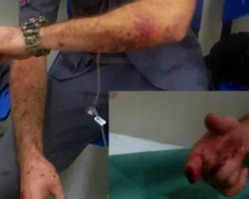 PM cai durante perseguição e tem dedo cortado a faca na Cracolândia 