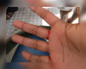 Passageira tem dedos cortados por prego em ônibus de Maceió
