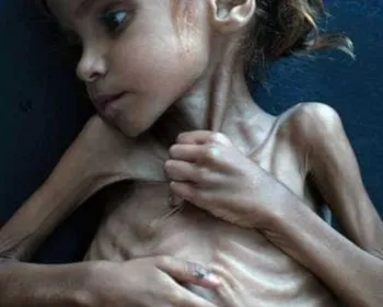 Morre menina símbolo de crise humanitária no Iêmen