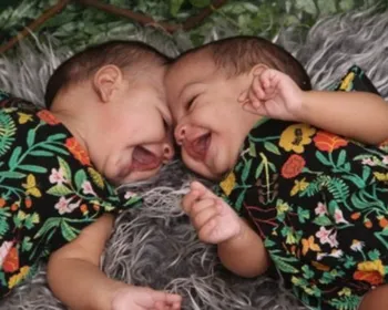 Após 20h de cirurgia, gêmeas siamesas são separadas no Distrito Federal