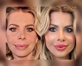 Cirurgião mostra antes e depois de preenchimento labial de Karina Bacchi