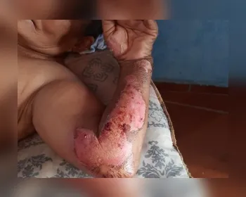 Agentes de saúde pedem pomada para idosa queimada viva pela filha em Arapiraca